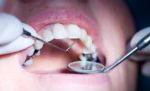Amalgamas dentales, peligro
